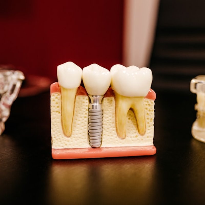 Dental implant consultation at Smile Spot Mawson Lakes